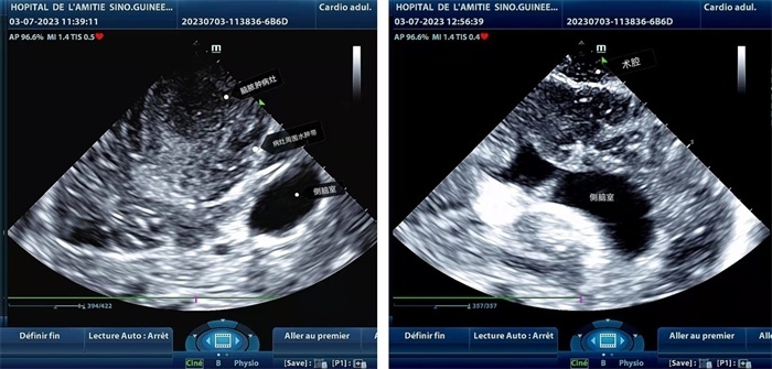 左圖顯示術(shù)中超聲見囊實性病變，大小約為4x4x3cm，病灶周圍腦組織水腫明顯；右圖為病灶切除后，術(shù)中超聲示術(shù)腔無病變殘留