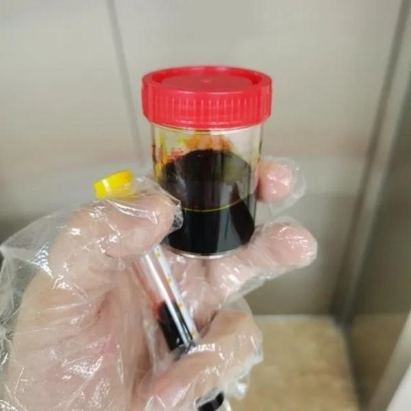 急性肝衰竭！兩兄弟誤吃這種菌 專家提醒