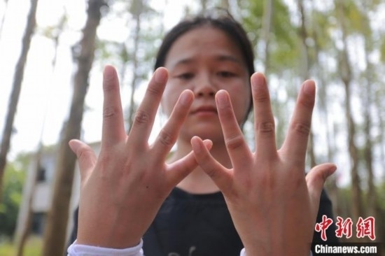 吳素英展示被蜜蜂蜇過(guò)的雙手。湯曉逵 攝