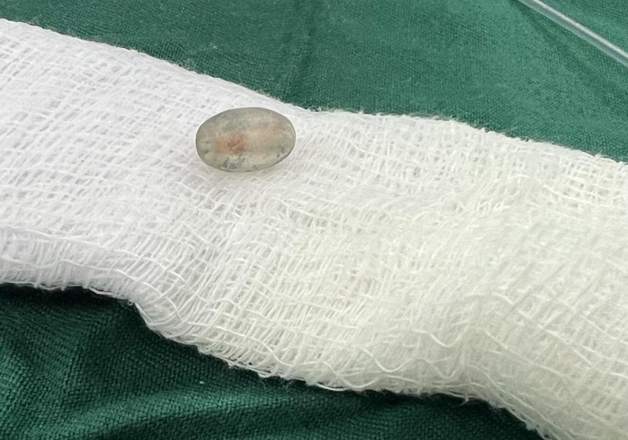 被取出的異物。中國援桑醫(yī)療隊(duì)供圖