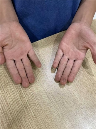 9歲小學(xué)生長期拍煙卡，手部粗糙長繭。受訪者供圖