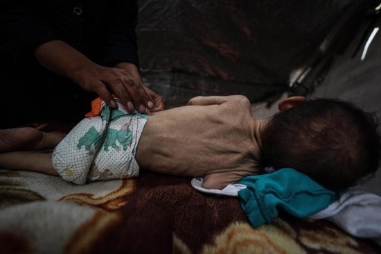 這是5月28日在加沙城西部一處臨時(shí)安置點(diǎn)拍攝的一名營養(yǎng)不良的嬰兒。新華社發(fā)（馬哈茂德·扎基攝）